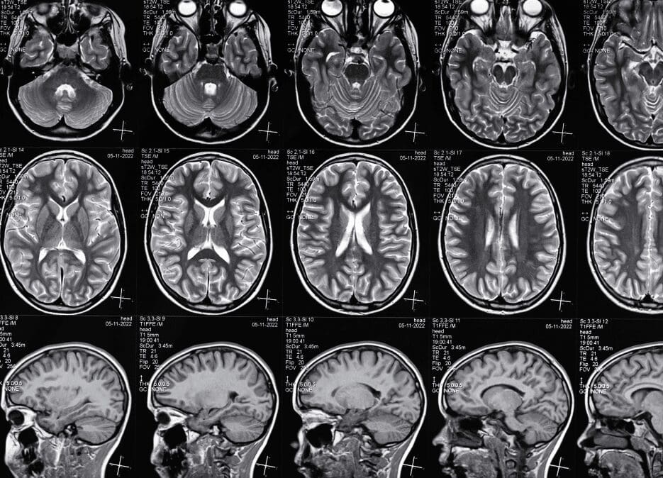 How-is-a-TBI-caused Traumatic brain injuries can be caused by sudden injuries to the head, including in car accidents.